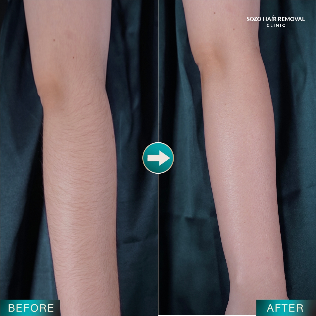 [LP Sleek] SEM for Adgroup - Arms - Before After - v2