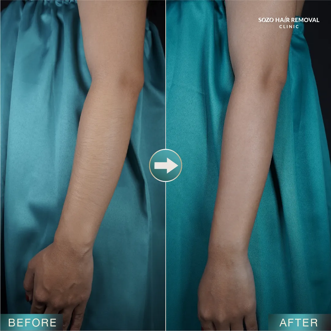[LP Sleek] SEM for Adgroup - General - Arms - Before After - v3