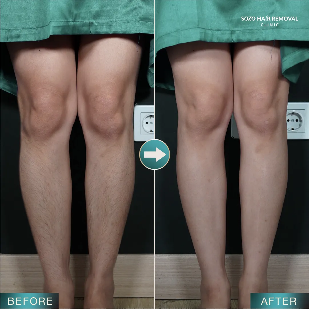 [LP Sleek] SEM for Adgroup - Legs - Before After - v1