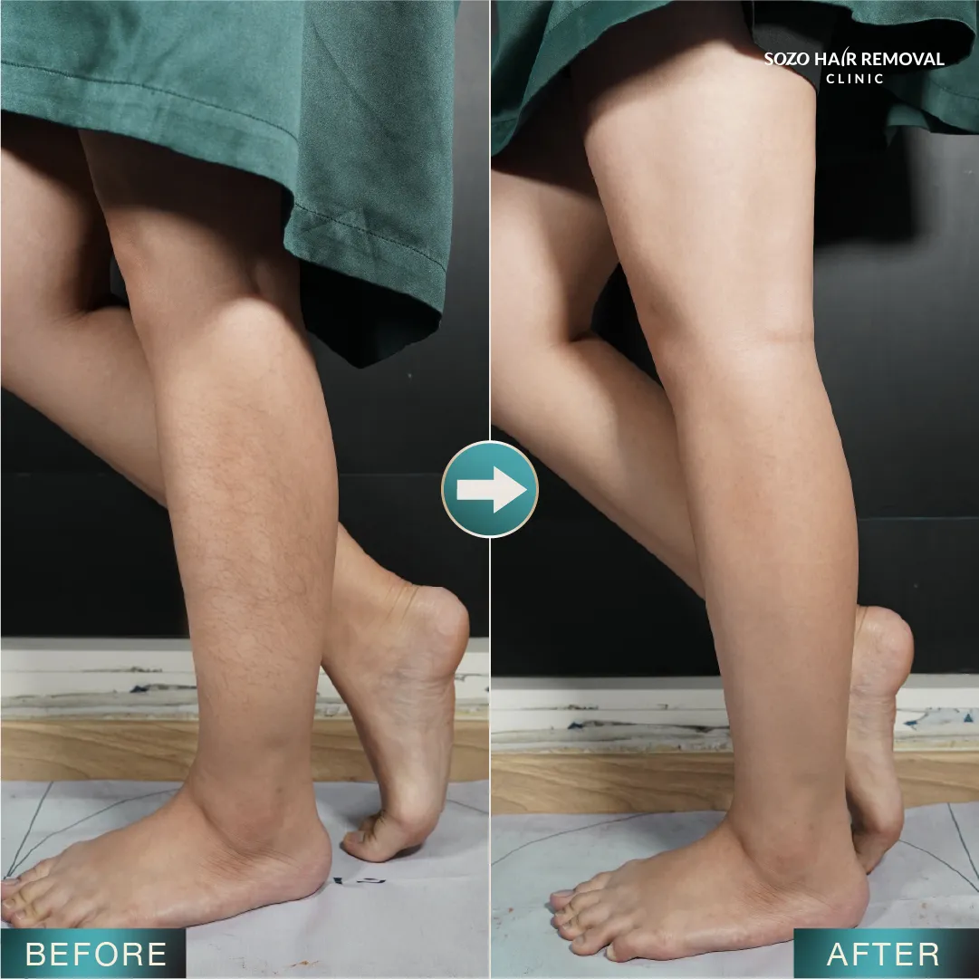 [LP Sleek] SEM for Adgroup - Legs - Before After - v2