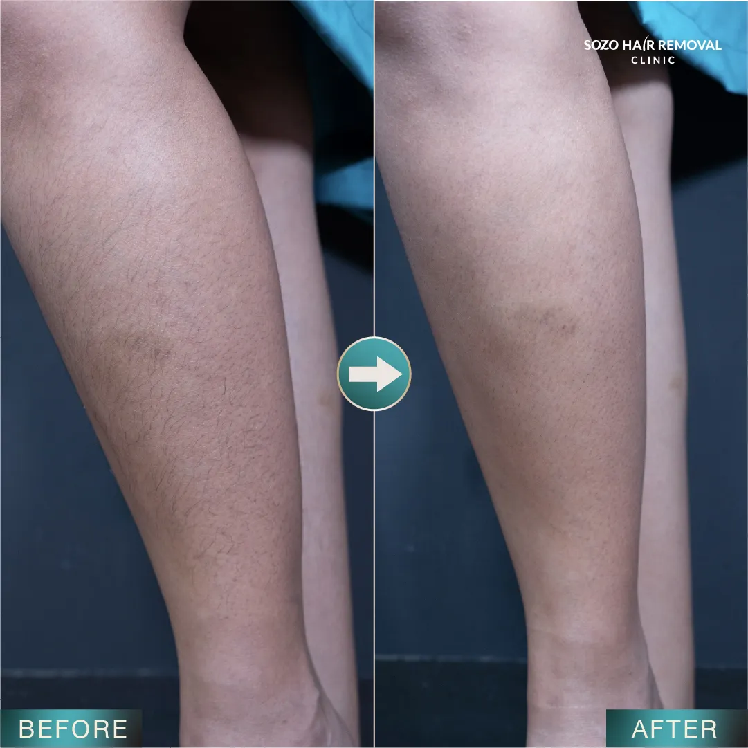 [LP Sleek] SEM for Adgroup - Legs - Before After - v3