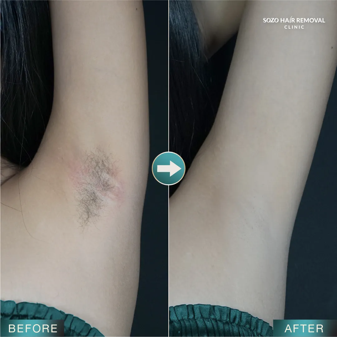 [LP Sleek] SEM for Adgroup - Underarm - Before After - v1