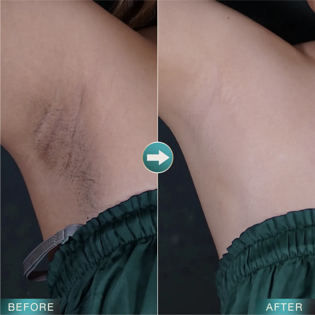 [LP Sleek] SEM for Adgroup - Underarm - - Before After - v2