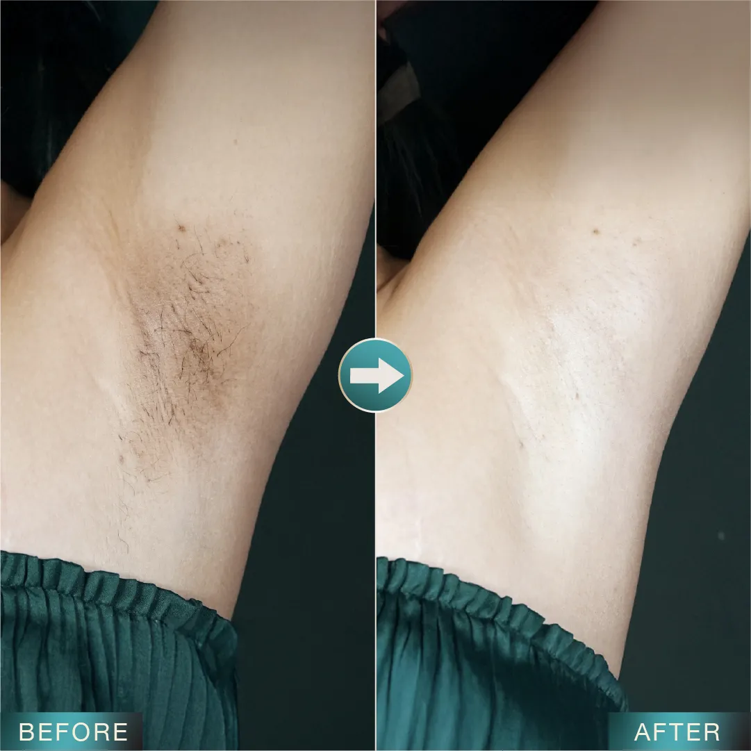 [LP Sleek] SEM for Adgroup - Underarm - Before After - v3